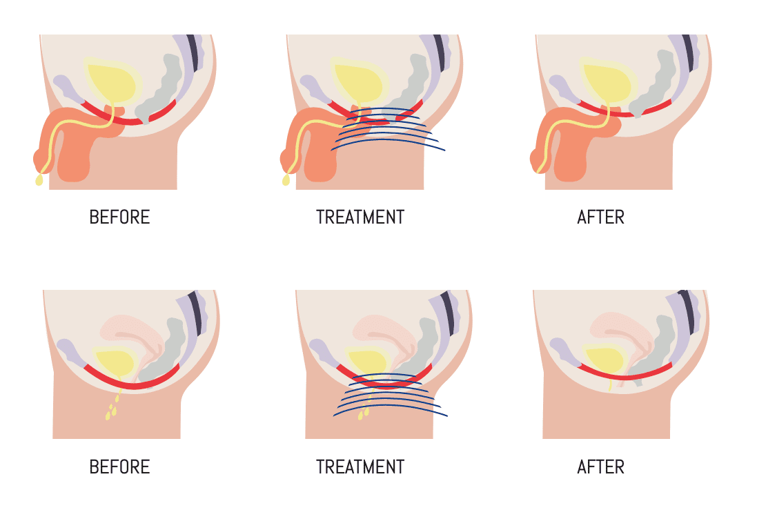 Pelvic organ prolapse treatment before and after